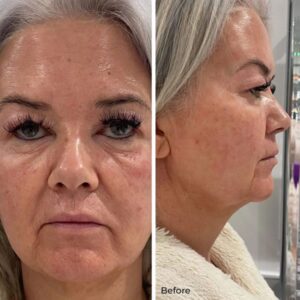 Image courtesy of Skin Sanctuary, Doncaster - Before NeoGen