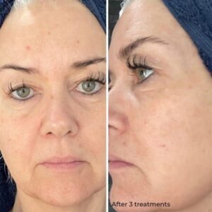 Image courtesy of Skin Sanctuary, Doncaster - After 3 treatments