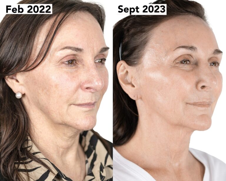 NeoGen Shirley Ballas 2 before and after