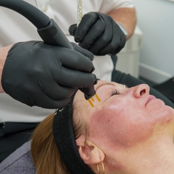 NEOGEN cheek treatment