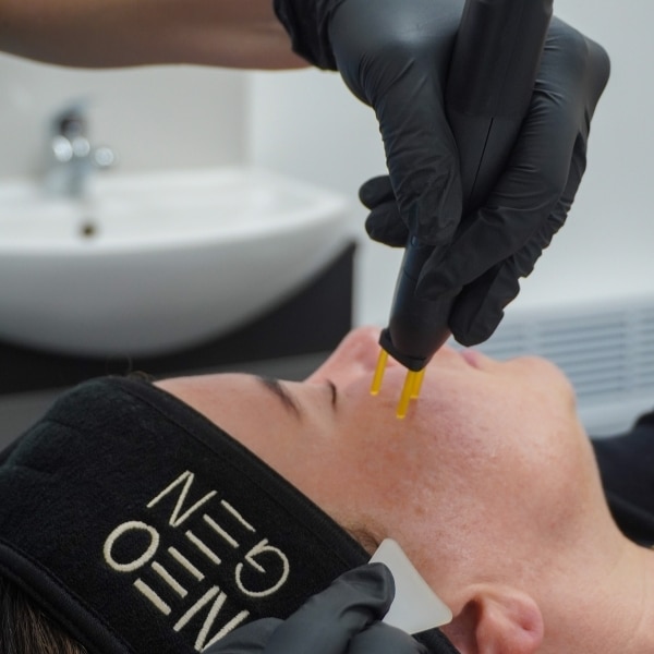 NEOGEN cheek treatment 2
