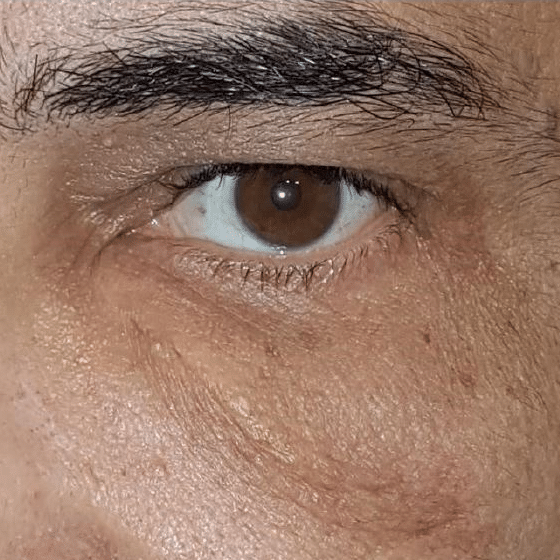 After NeoGen treatment, under-eye and eyelid area