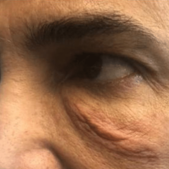 Before NeoGen treatment, under-eye and eyelid area