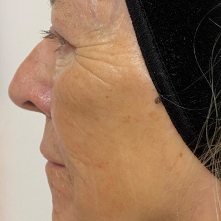 Side profile of the same cheek and eye area after NeoGen treatment