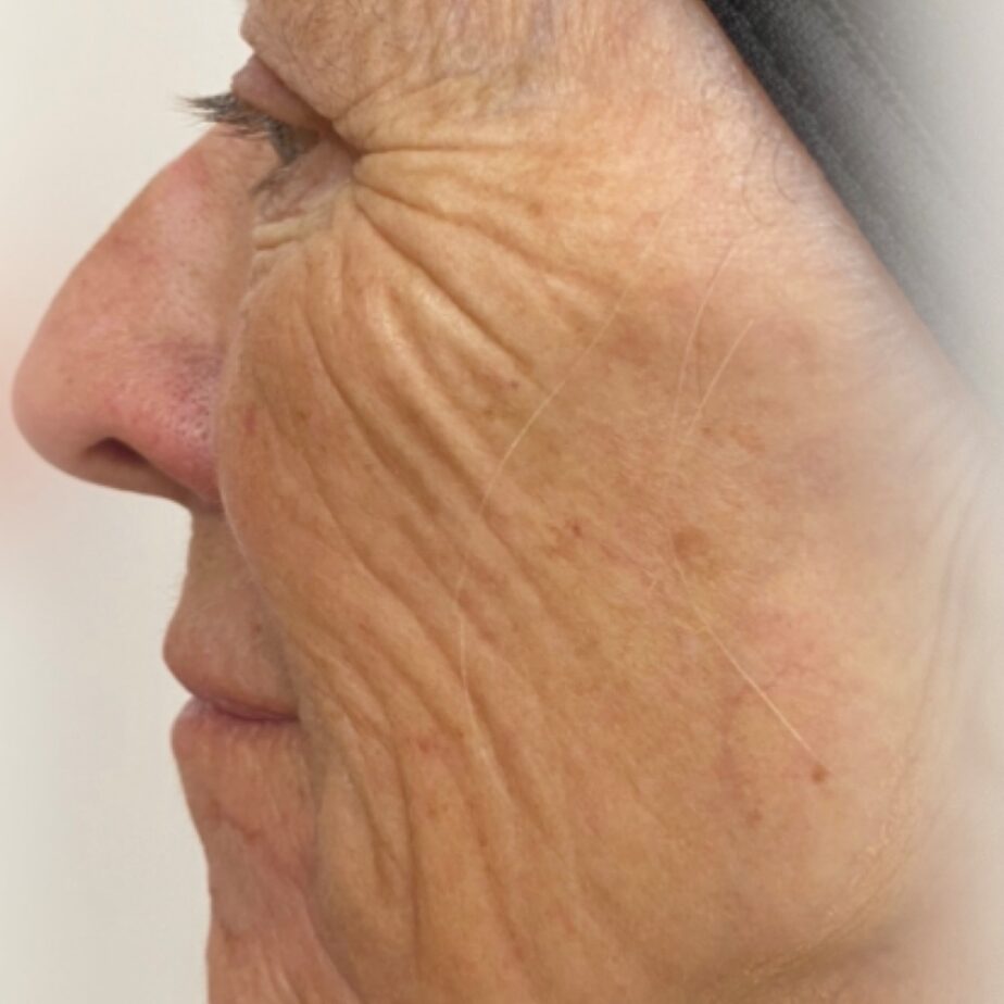 Side profile of a woman’s cheek and eye area with deep wrinkles, before NeoGen treatment