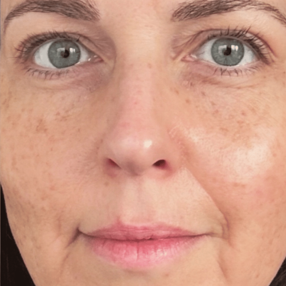 After NeoGen treatment, a 63-year-old woman’s face, showing texture and pigmentation