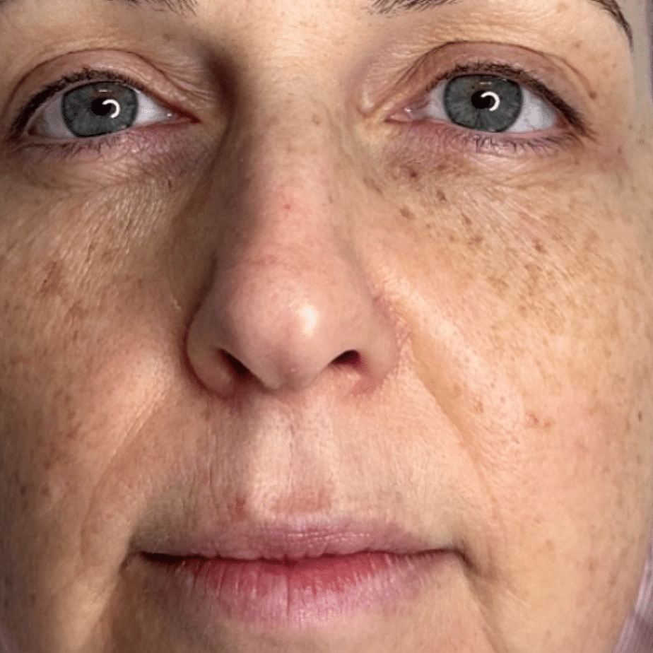 Before NeoGen treatment, a 63-year-old woman’s face, showing texture and pigmentation