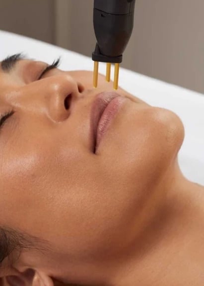 Woman lying back with eyes closed as a NeoGen handpiece with gold tips is held above her upper lip