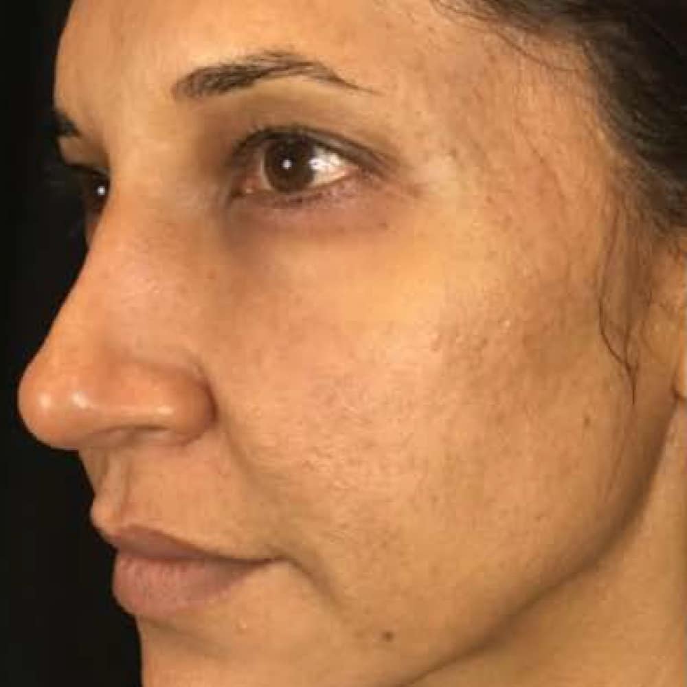 Before NeoGen treatment, a cheek in three-quarter view showing acne scarring and uneven skin texture