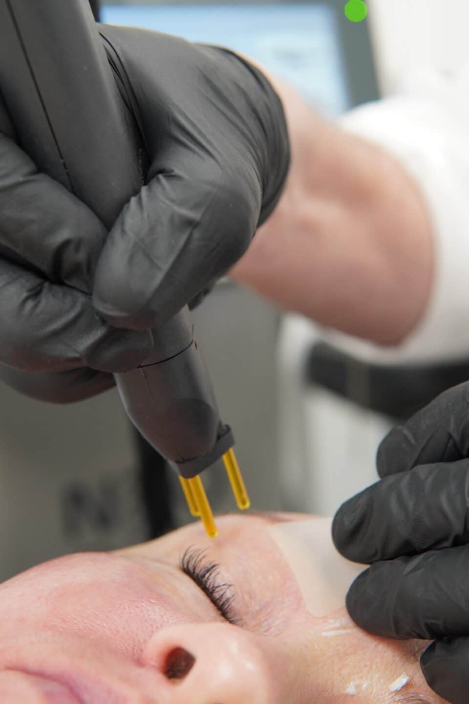 Close-up of a gloved practitioner holding the NeoGen handpiece at the corner of a patient’s eye
