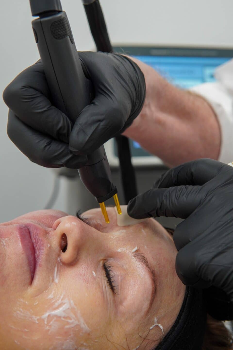 NeoGen handpiece treating the skin at the outer corner of a patient’s closed eye