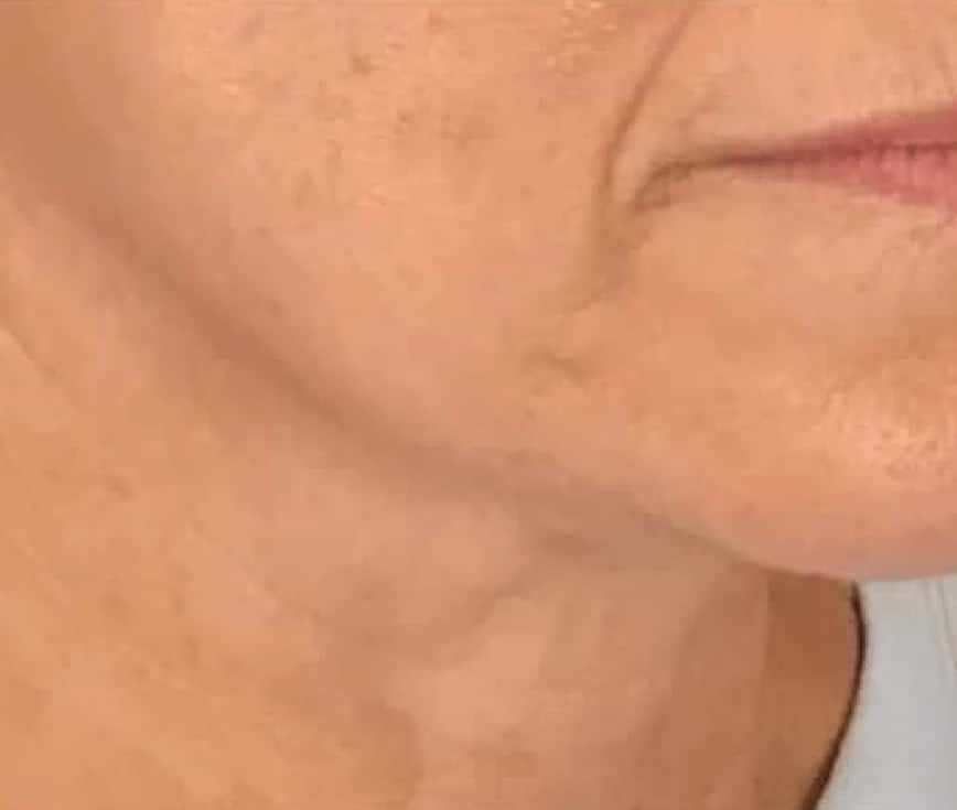 Close-up of a woman’s lower face, jawline and neck, seen from the side
