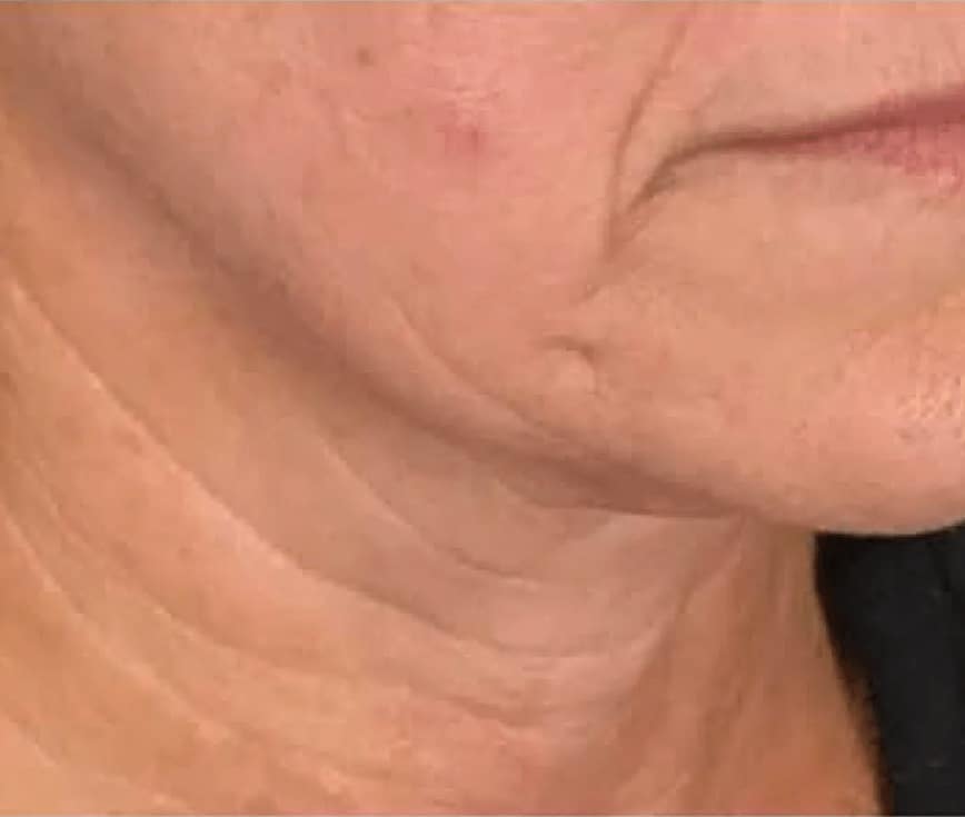 Close-up of a woman’s lower face, jawline and neck, seen from the side