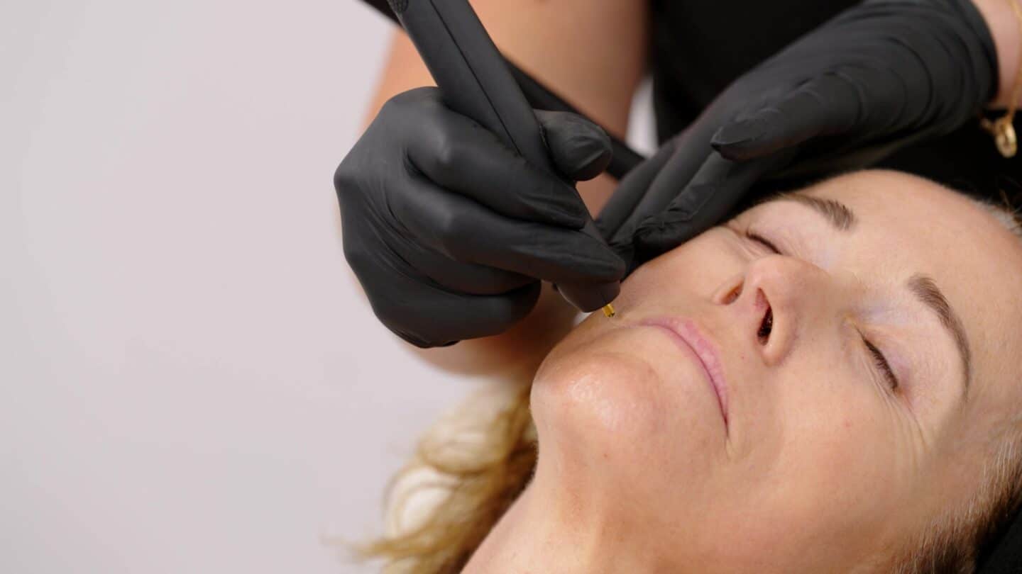 Close-up of the NeoGen handpiece treating a patient’s upper cheek