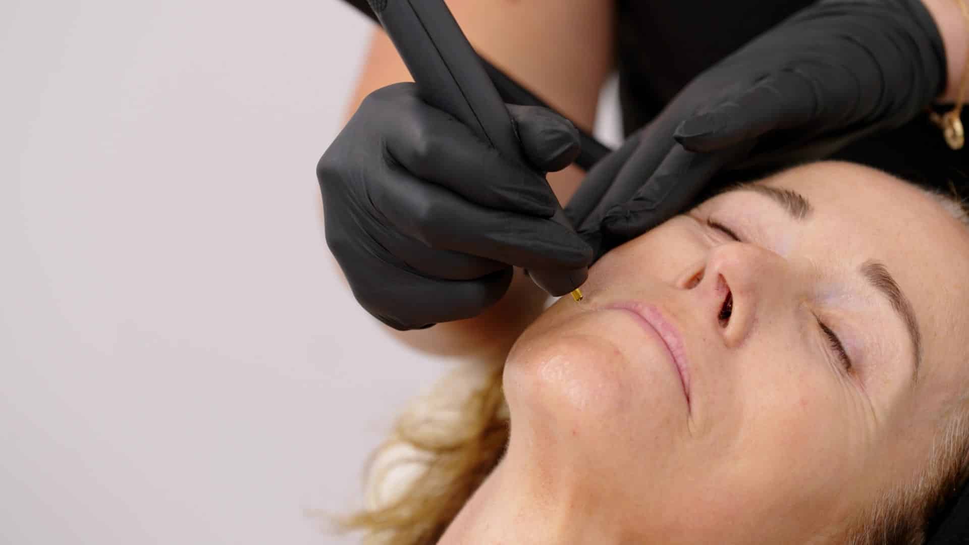 Close-up of the NeoGen handpiece treating a patient’s upper cheek