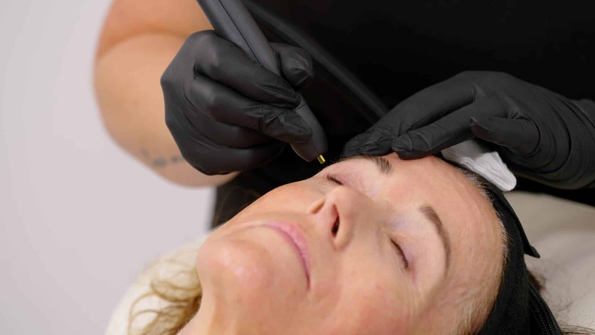 Gloved practitioner treating the skin beside a patient’s eye with the NeoGen handpiece