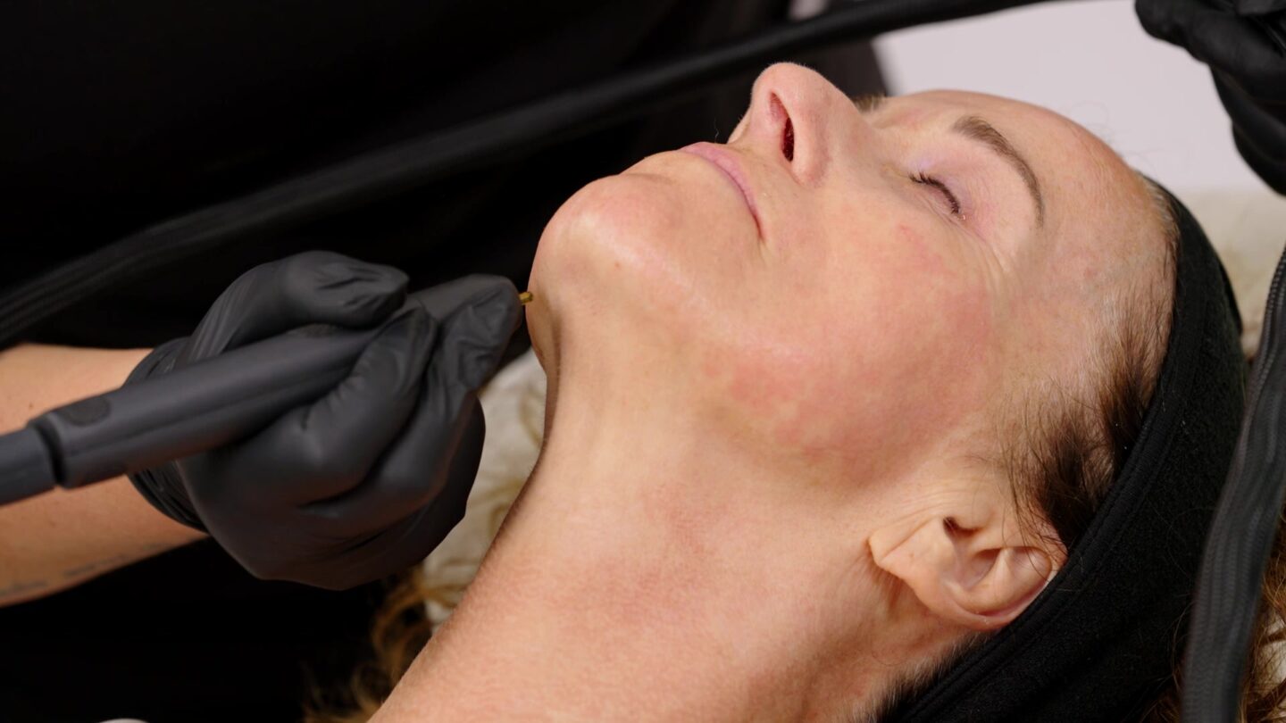 Practitioner treating a patient’s jawline with the NeoGen handpiece