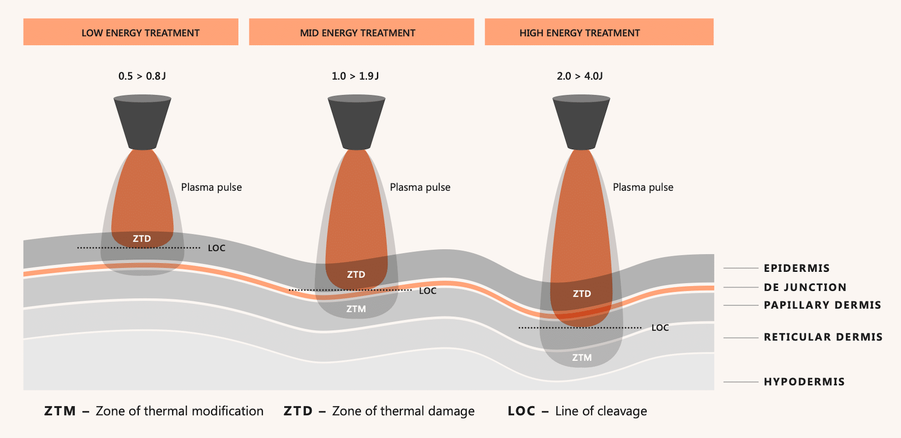 Diagram of low, mid and high energy NeoGen plasma pulses and the skin layers each one reaches