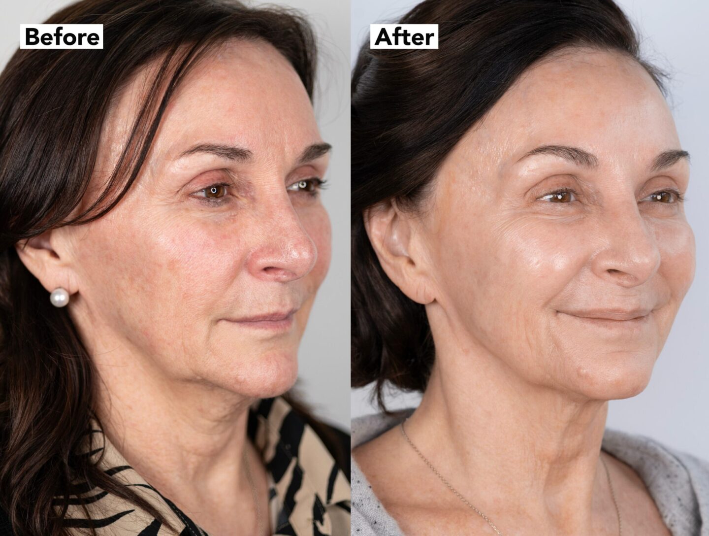 Shirley Ballas before and after her NeoGen nitrogen plasma treatments, shown side by side