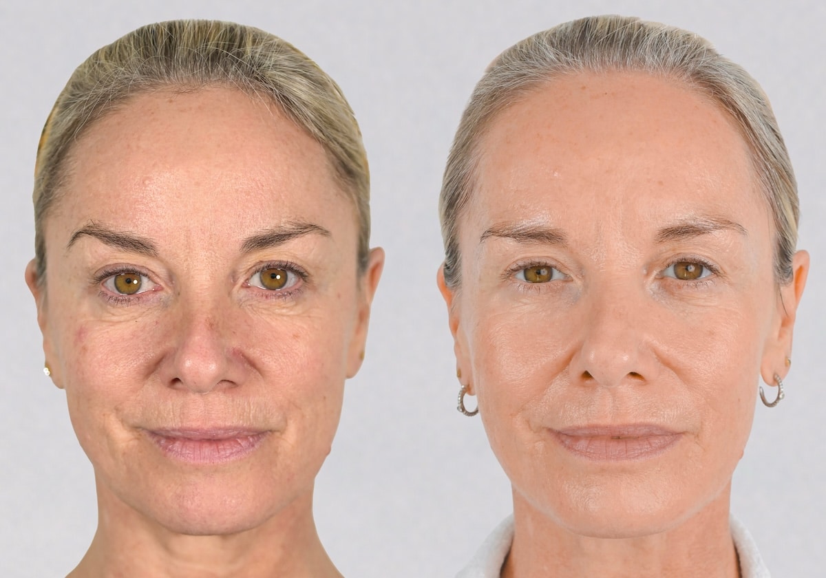 Tamzin Outhwaite before and after her NeoGen treatments, front view side by side