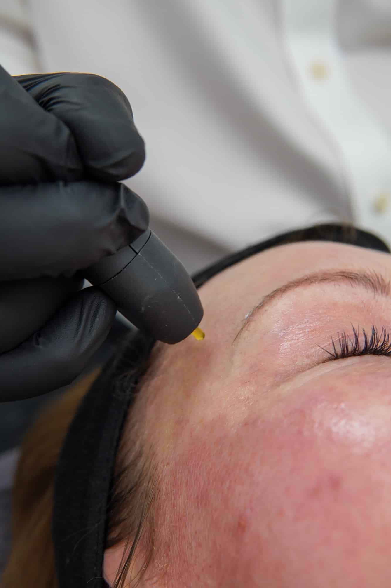 Gloved practitioner holding the NeoGen handpiece beside a patient’s brow and eye area