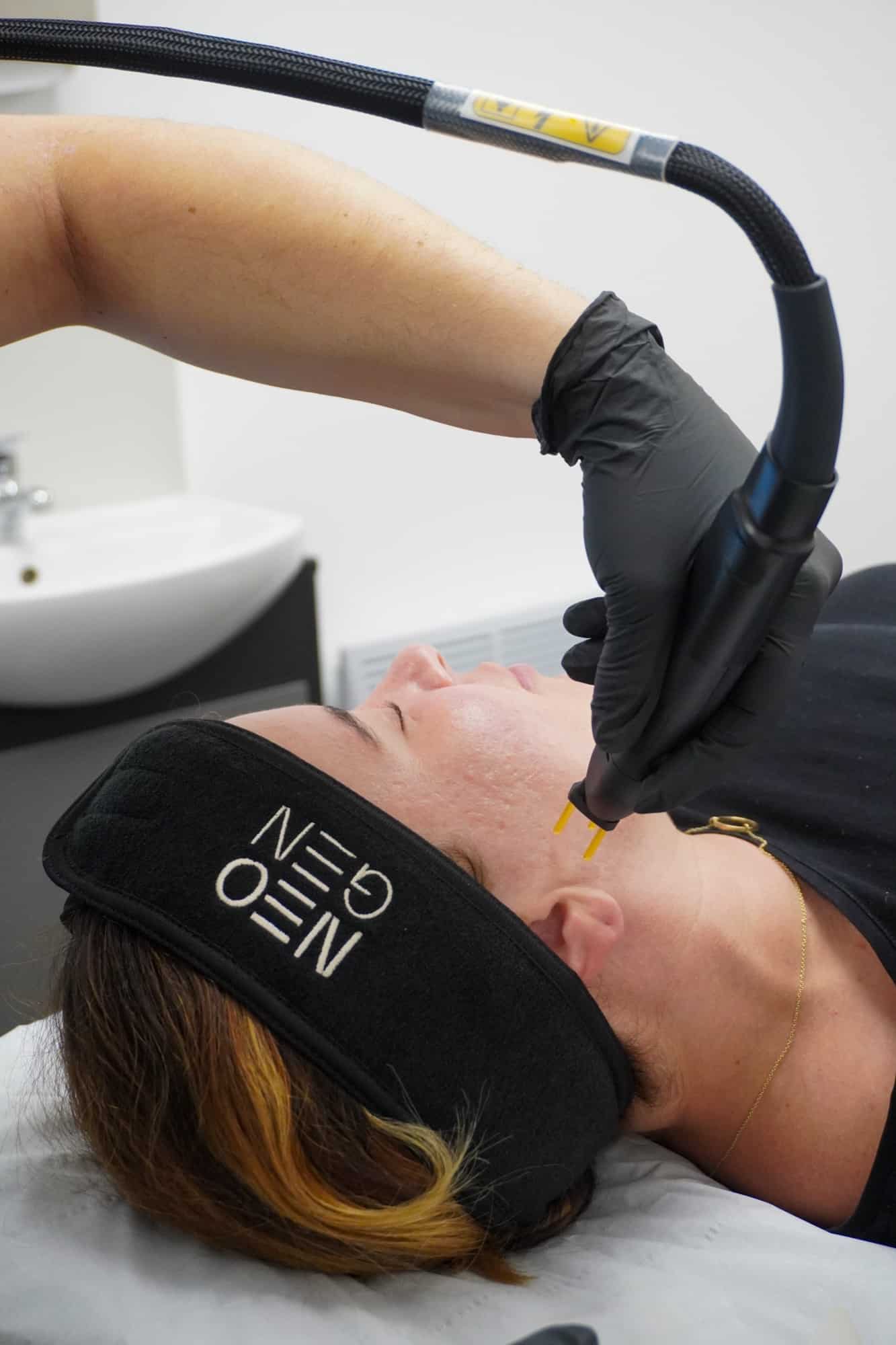Patient in a NeoGen headband having the lower face treated with the NeoGen handpiece